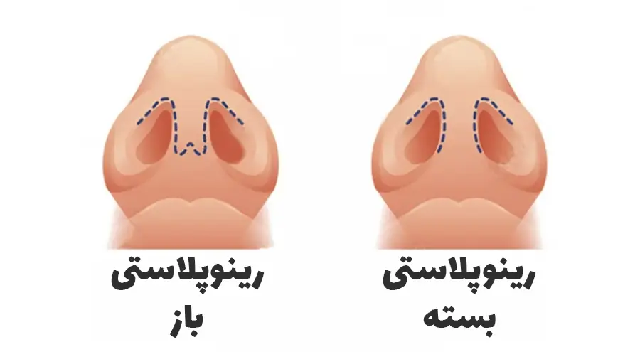 مقایسه رینوپلاستی باز و بسته