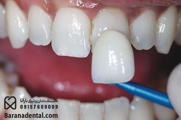 لمینت دندان راهنمای انتخاب رنگ لمینت دندان