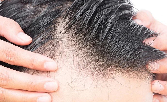 &nbsp;بهترین راهکارها برای جلوگیری از ریزش مو در هر نوع مو